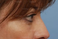 eyelid rejuvenation patient