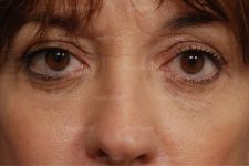 eyelid rejuvenation patient