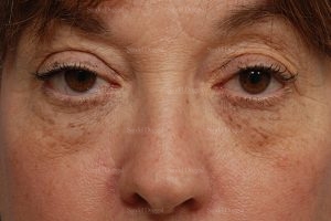 eyelid rejuvenation patient