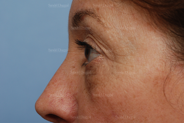 eyelid rejuvenation patient