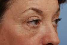 eyelid rejuvenation patient
