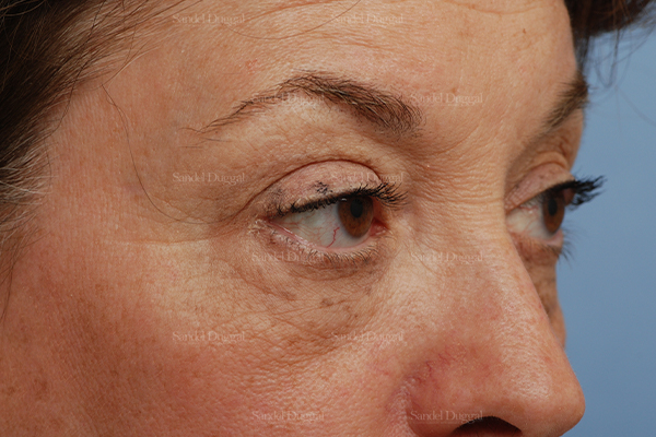eyelid rejuvenation patient