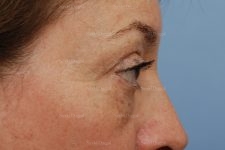 eyelid rejuvenation patient