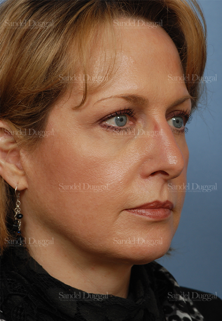 facelift patient