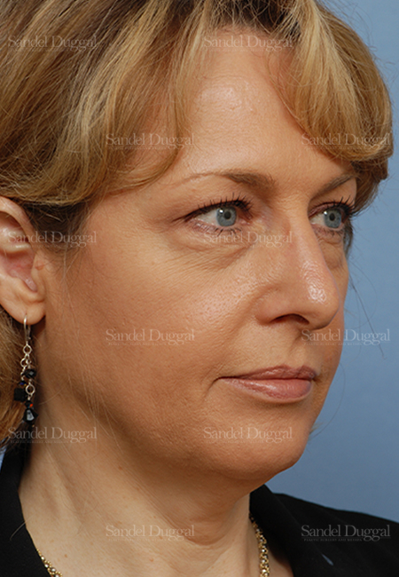 facelift patient