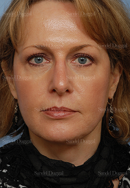 facelift patient