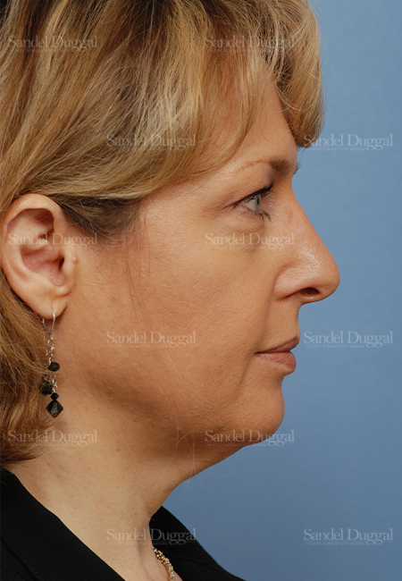 facelift patient