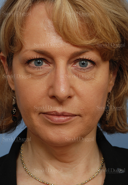facelift patient