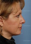facelift patient