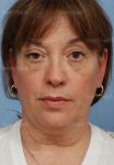 facelift patient