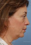 facelift patient