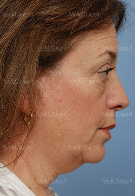 facelift patient