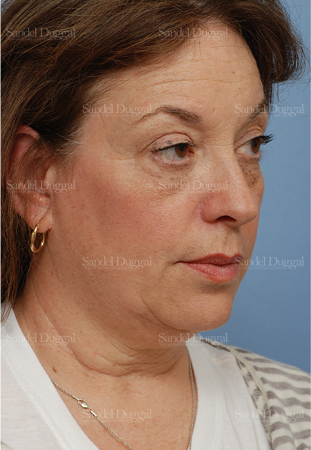 facelift patient