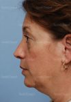 facelift patient