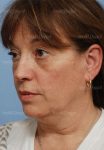 facelift patient