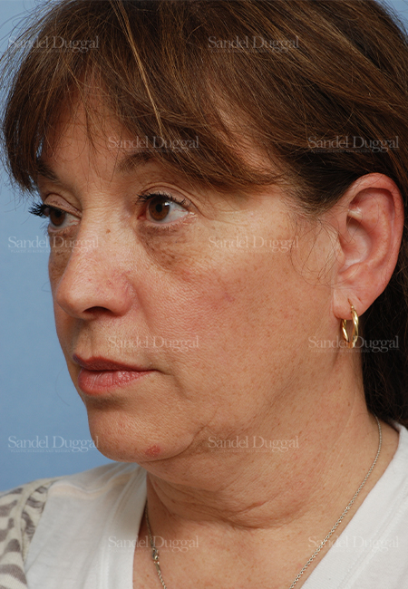 facelift patient