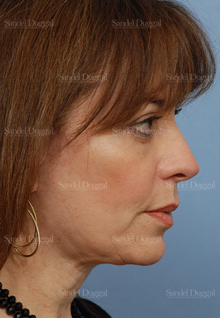 facelift patient