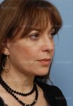 facelift patient