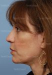 facelift patient