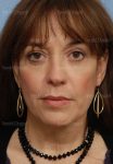 facelift patient