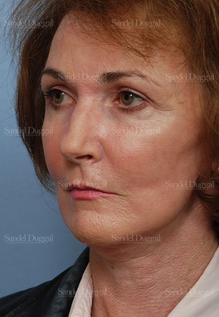 cheek augmentation patient