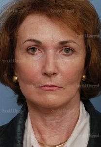 cheek augmentation patient