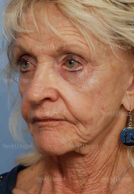 cheek augmentation patient