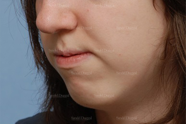 chin augmentation patient