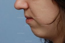 chin augmentation patient