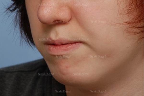 chin augmentation patient