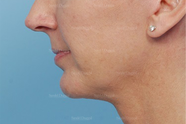 chin augmentation patient