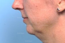 chin augmentation patient