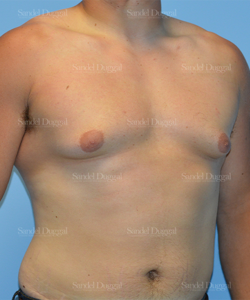 gynecomastia patient