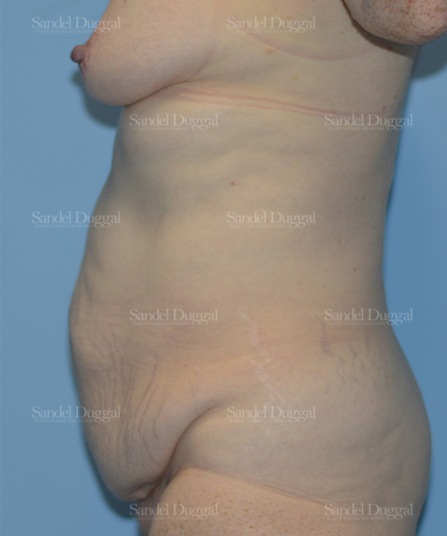 tummy tuck patient