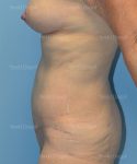 tummy tuck patient
