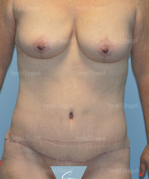 tummy tuck patient