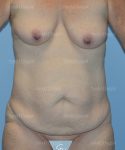 tummy tuck patient