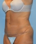 tummy tuck patient