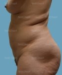 tummy tuck patient