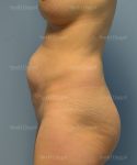 tummy tuck patient