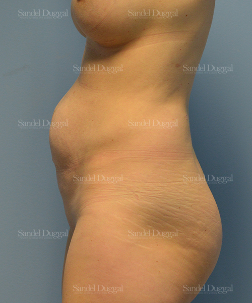 tummy tuck patient