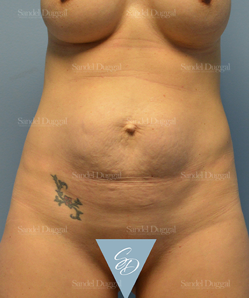 tummy tuck patient