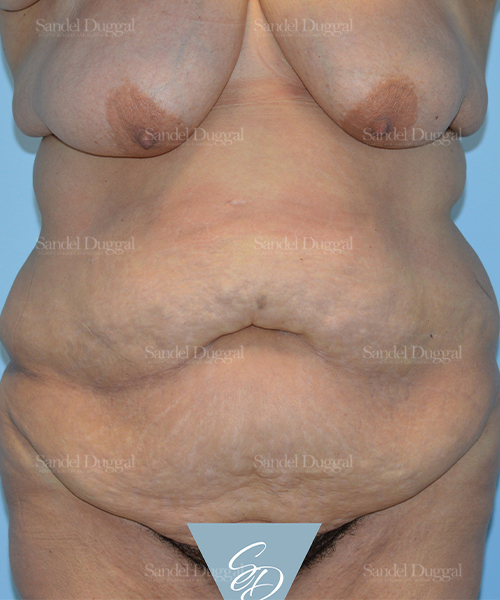 tummy tuck patient