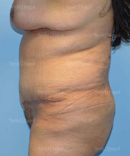 tummy tuck patient