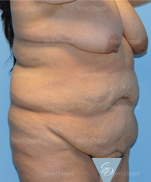 tummy tuck patient