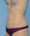 tummy tuck patient