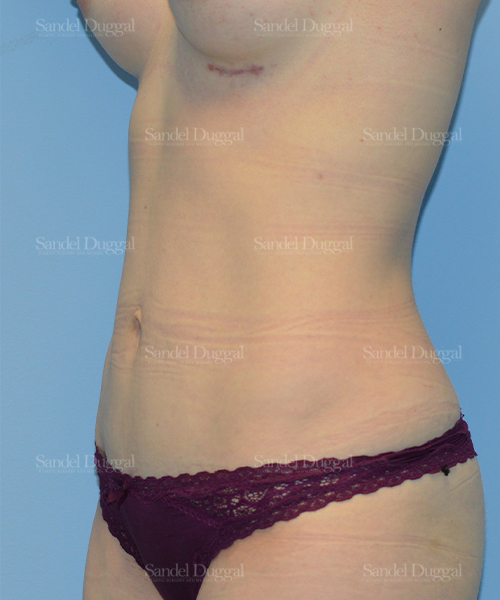 tummy tuck patient