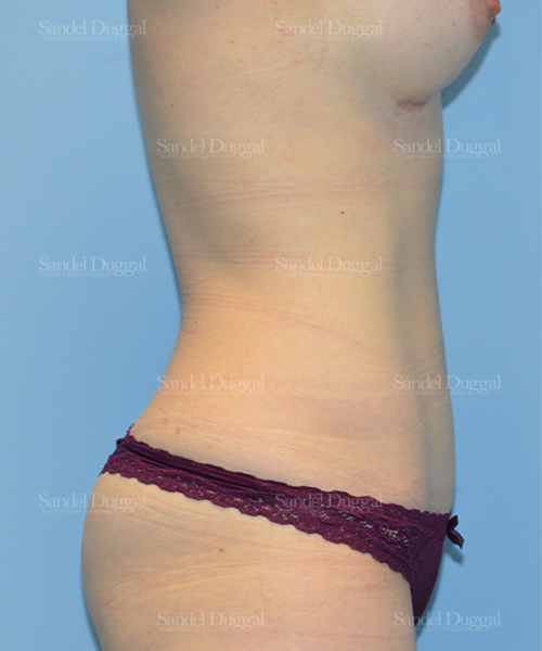 tummy tuck patient