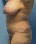 tummy tuck patient