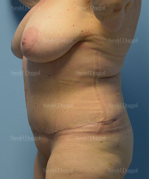 tummy tuck patient
